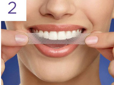 moment nakladania paskow crest na luk zebowy